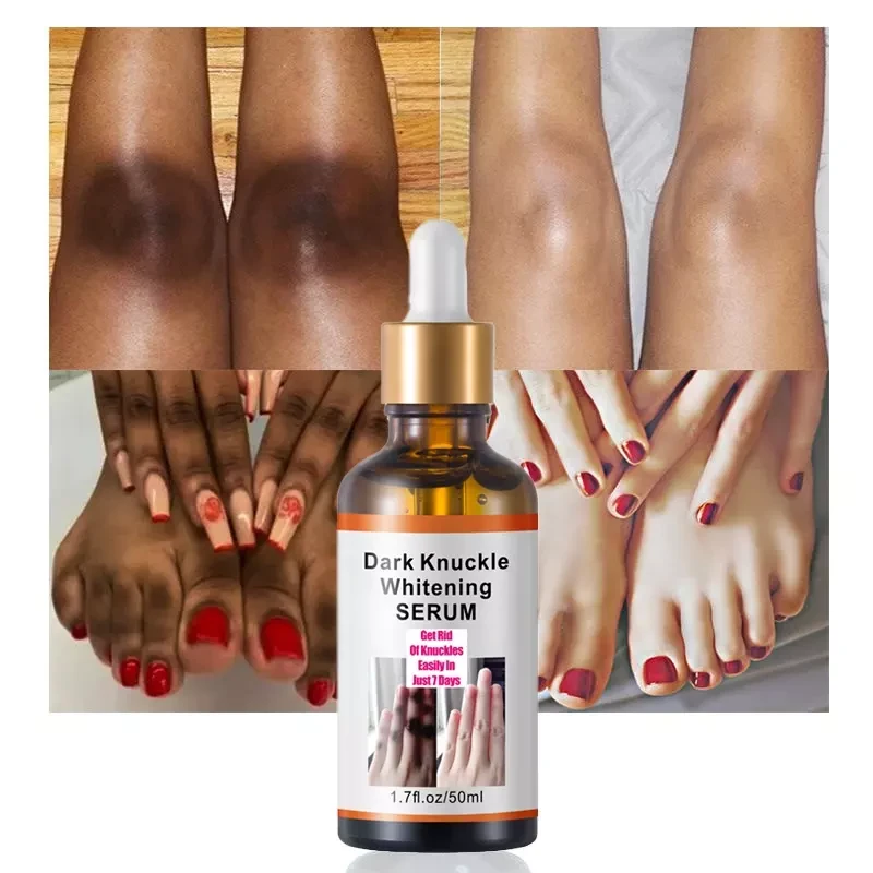 Dark Spots On Toe Knuckles atelieryuwa.ciao.jp