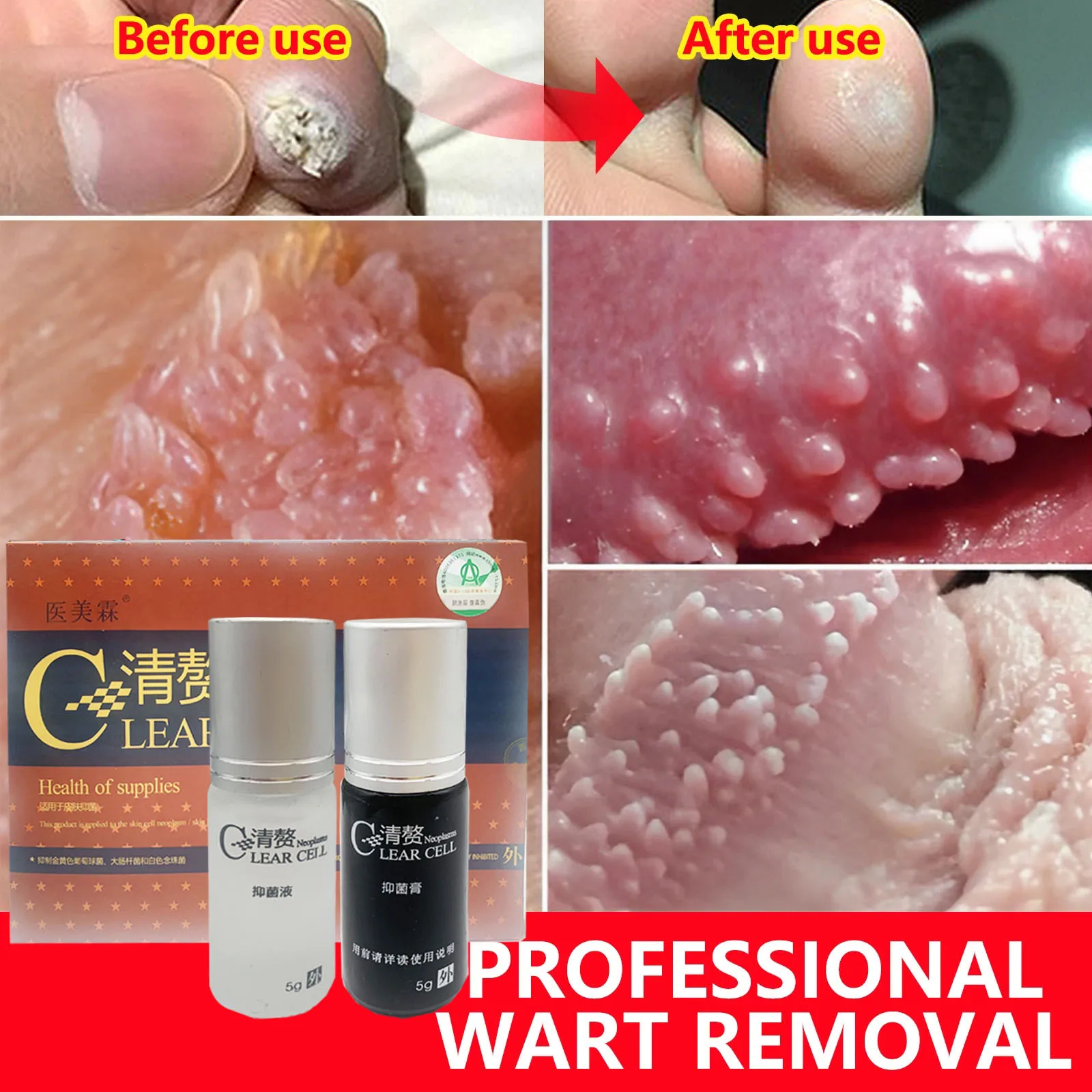 

3pcs 5g Wart Removal Liquid Against Mole Warts Repair Solution Plantar Feet Wart Treat Reduce Friction Dressing Skin Tag Remover