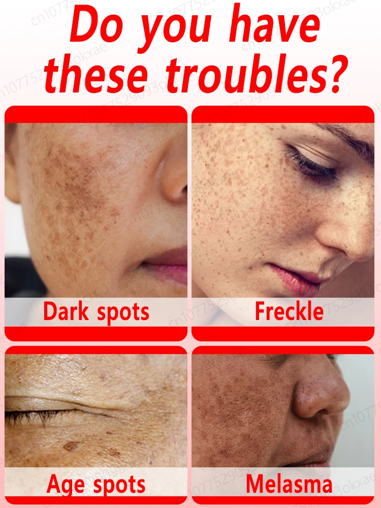 Anti-freckle essence, effectively removes dark spots, age spots, chloasma and freckles in 7 days 5