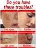 Anti-freckle essence, effectively removes dark spots, age spots, chloasma and freckles in 7 days 5