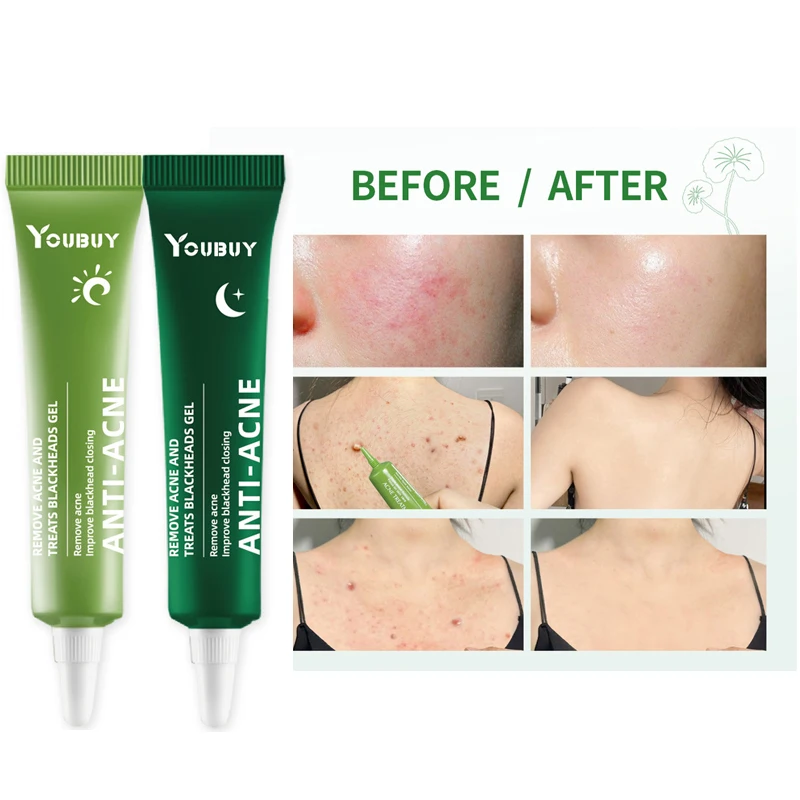 

Acne Removal Whitening Cream Effective Fade Acne Spots Repair Gel Oil Control Moisturizing Shrink Pores Acne Treatment Skin Care