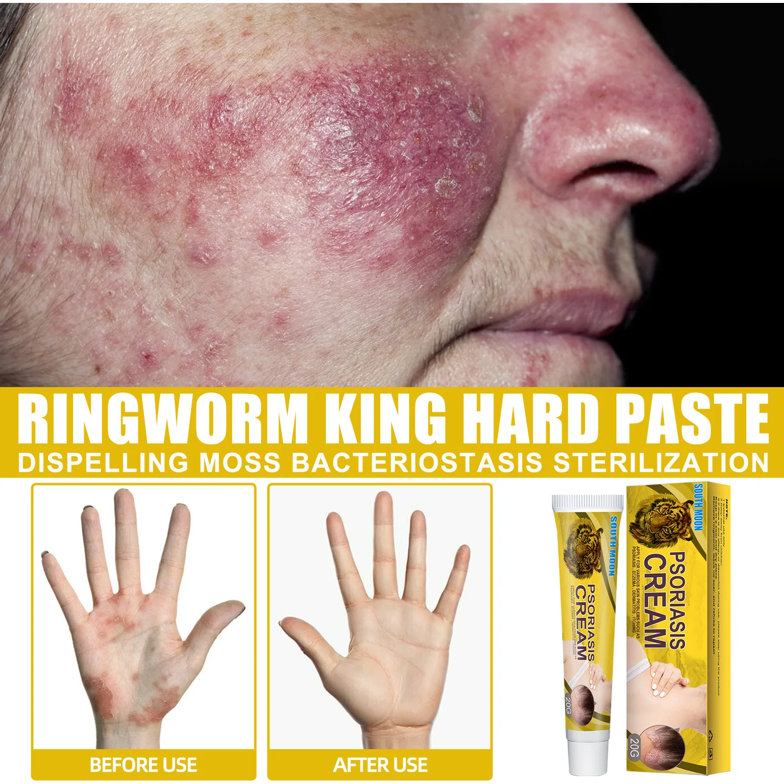 Ringworm Treatment Cream