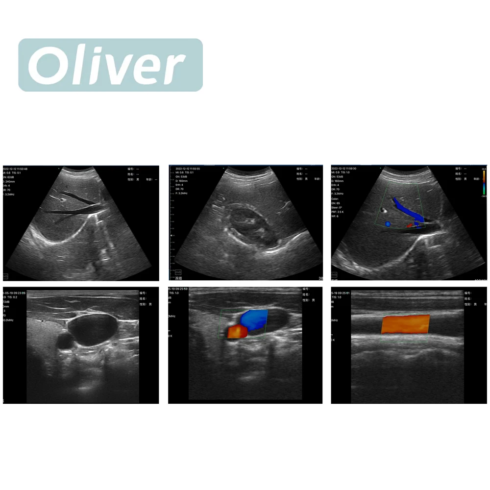 Sonda de ultrasonido inalámbrica de 256 elementos y 64 canales, escáner portátil con Wi-Fi, Doppler color, lineal y convexo 3 en 1