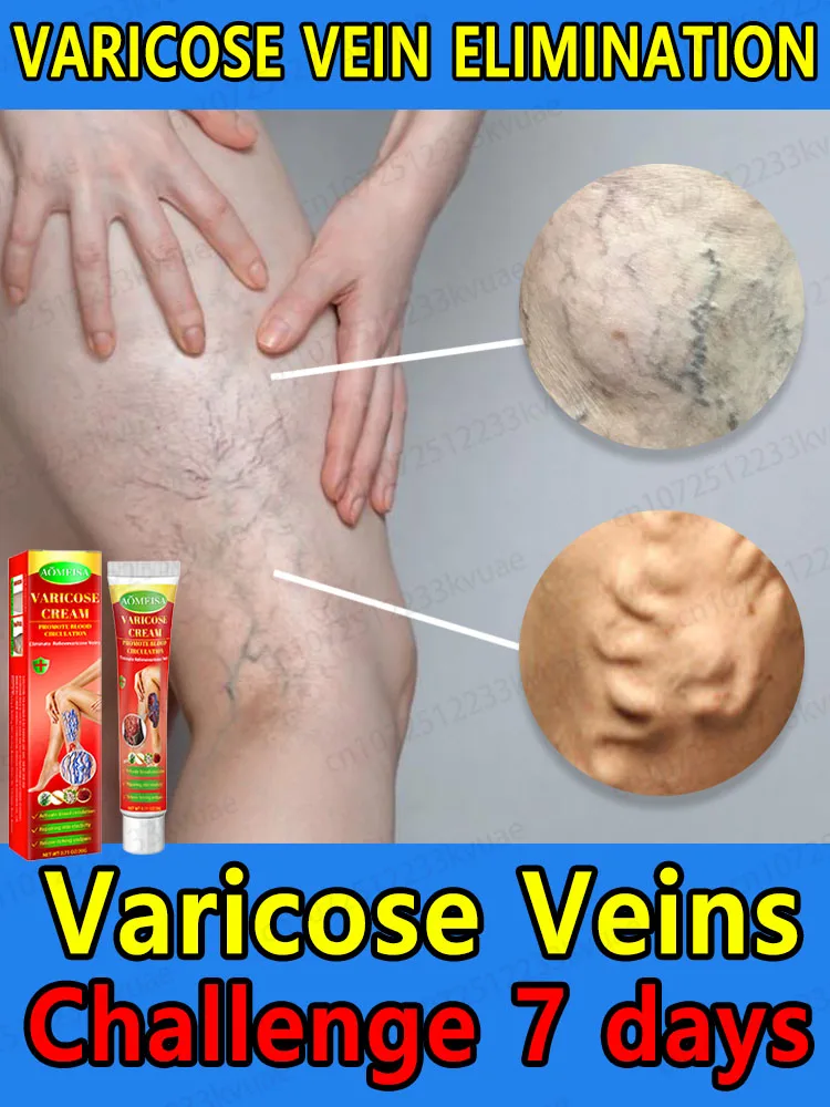 

Ointment for Varicose Veins Eliminate Spider Legs Spider Vein to Relieve Vasculitis Phlebitis Spider Pain Treatment Varicose Vei