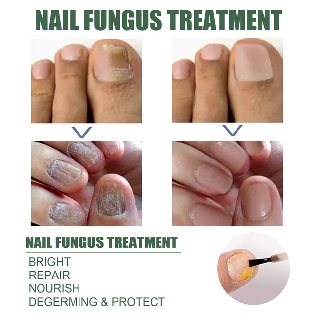 Toenail F ngus Treatment Extra Strength Nail Repair Liquid for Toenail and Fingernail  Nail Repair Solution for Thick Cracked Discolored Nails Restore Healthy  Nails 1 Count (Nail Repair Liquid)