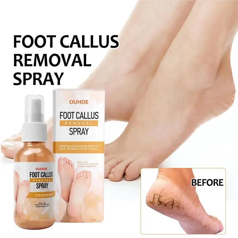 Foot Callus Removal Spray 1.01 Oz Dry Feet Skin Remover Foot Care