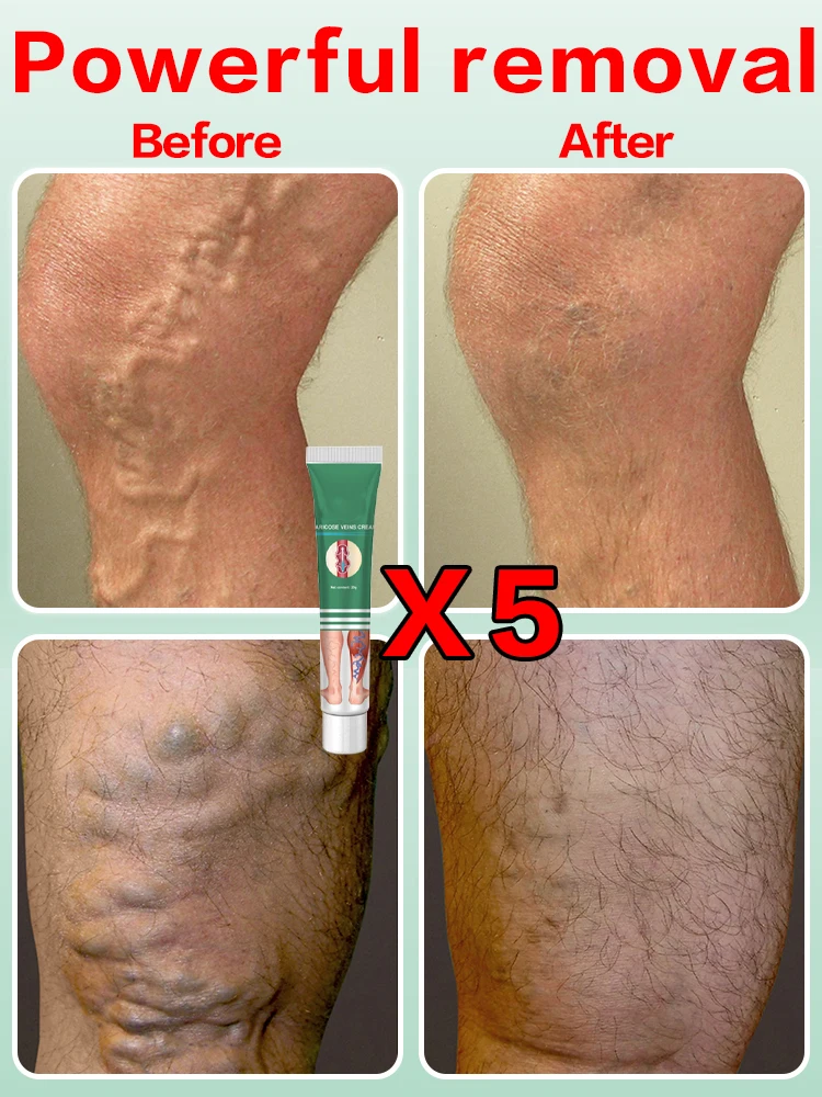 Pomada para varizes Creme eficaz al&iacute;vio das veias varicosas alitivar a vasculite flebite aranha dor tratamento