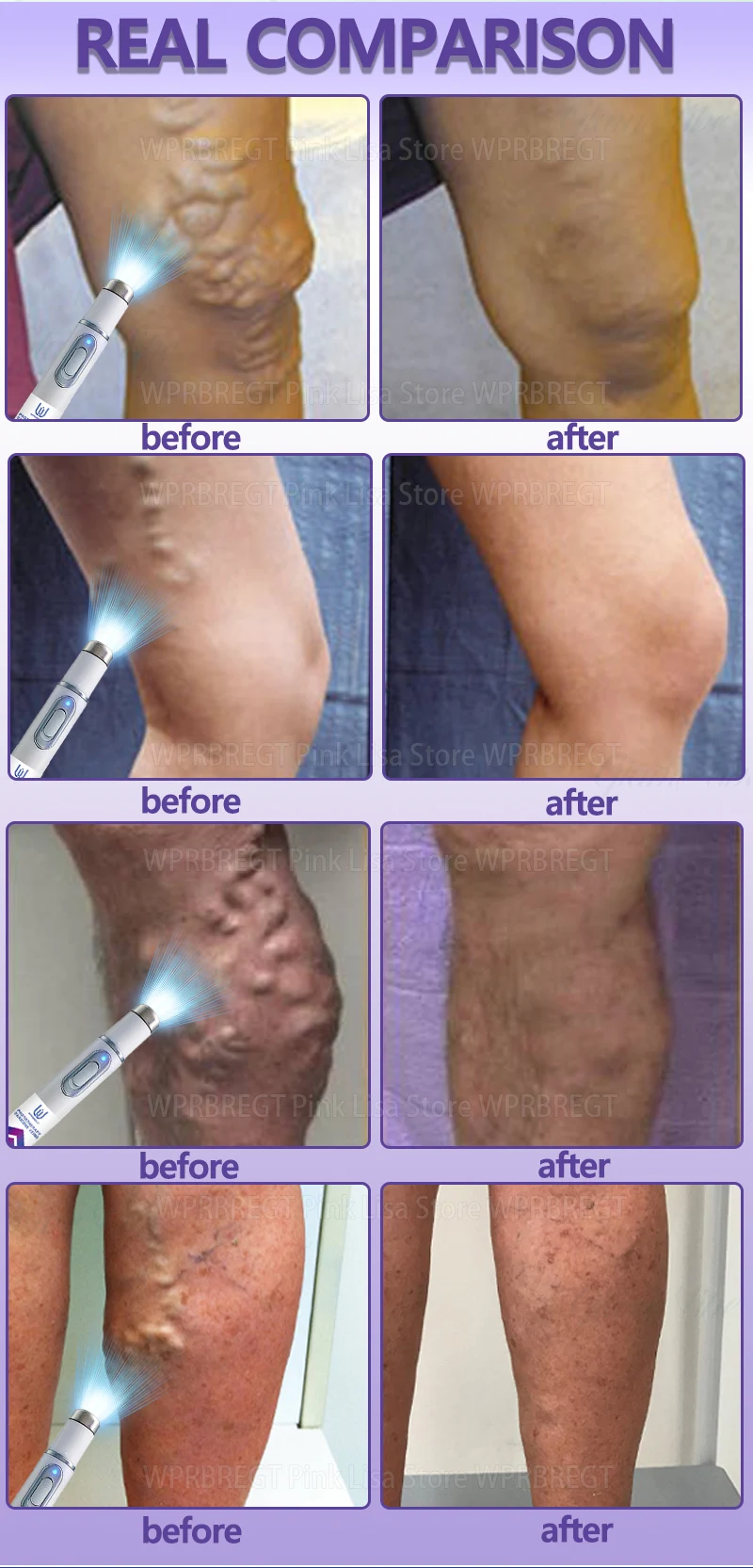 2nd generation varicose vein laser eliminates vasculitis and phlebitis, relieves spider leg pain, laser pointer for treatment