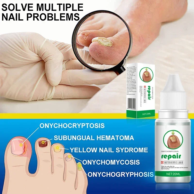 

SUAI Nail Fungus Treatment Oil Foot Repair Essence Toe Nail Fungus Removal Gel Anti Infection Cream Fungal Nail Removal 20ML