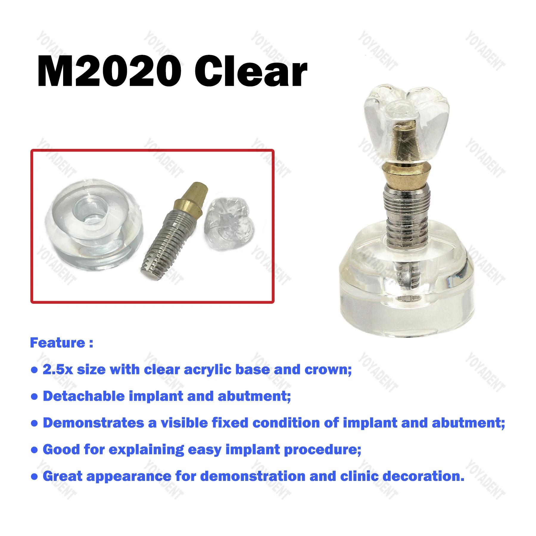 치과 치아 모형 티포돈트 임플란트 교육용 2.5배 확대 레진 모형 (치과의사 환자 상의용 데모)