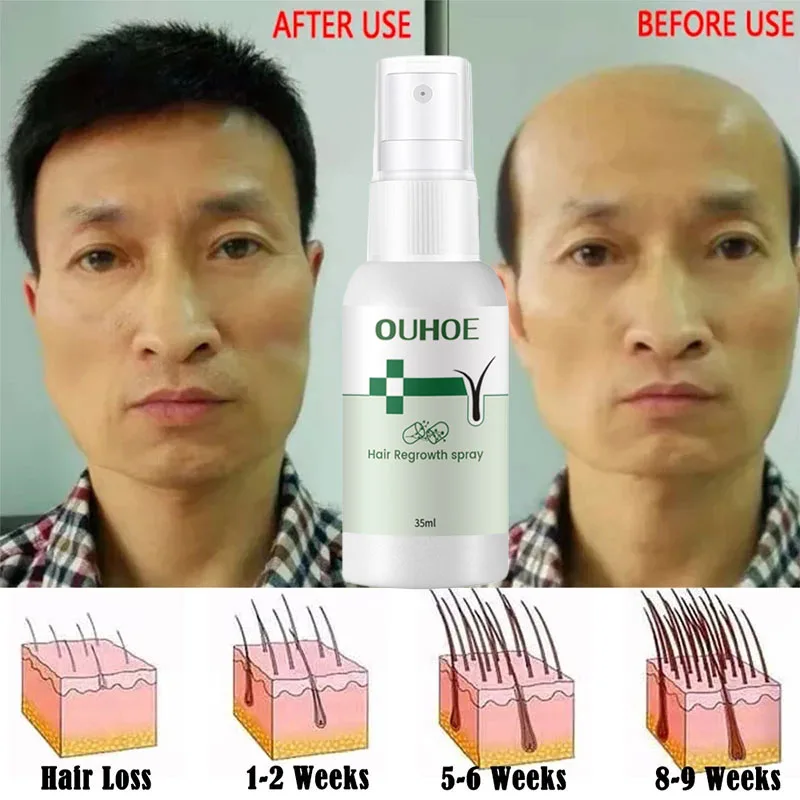 

10pcs Fast Hair Growth Spray Anti Hair Loss Effective Treatment Hereditary Hair Loss Postpartum Hair Loss Seborrheic Hair Loss
