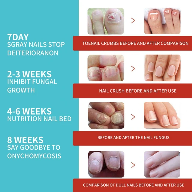 Topical Treatments Options for Toenail Fungus