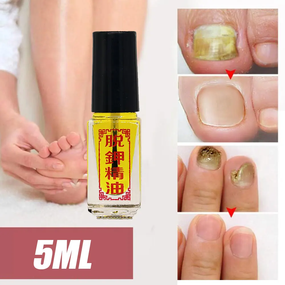 Nail Fungus Remover 3 Days Effect Nail Treatment Removal of onychomycosis Paronychia Anti oil Fungal Nail Infection Toe Fungus oil