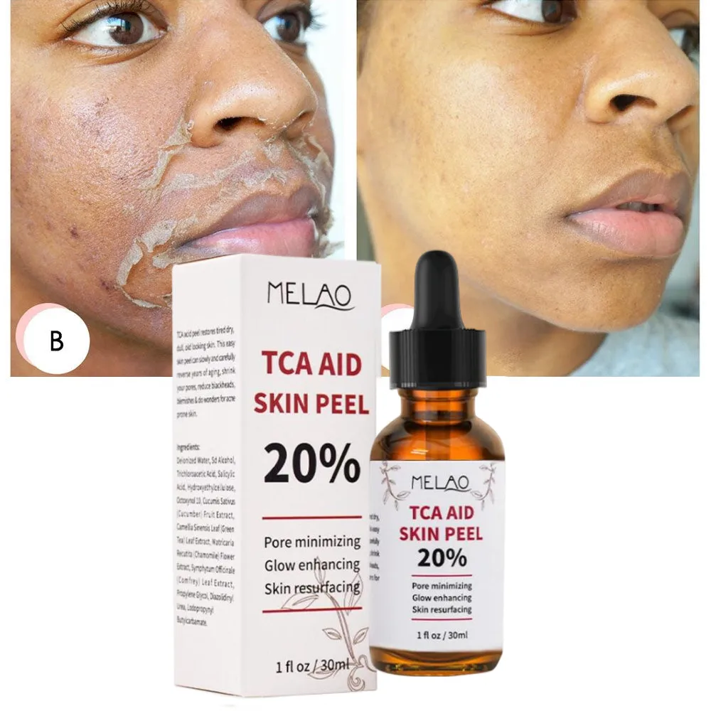 20TCAAidSkinPeelPores30mlTrichloroaceticAcidStockSolutionMinimizingBlackheads