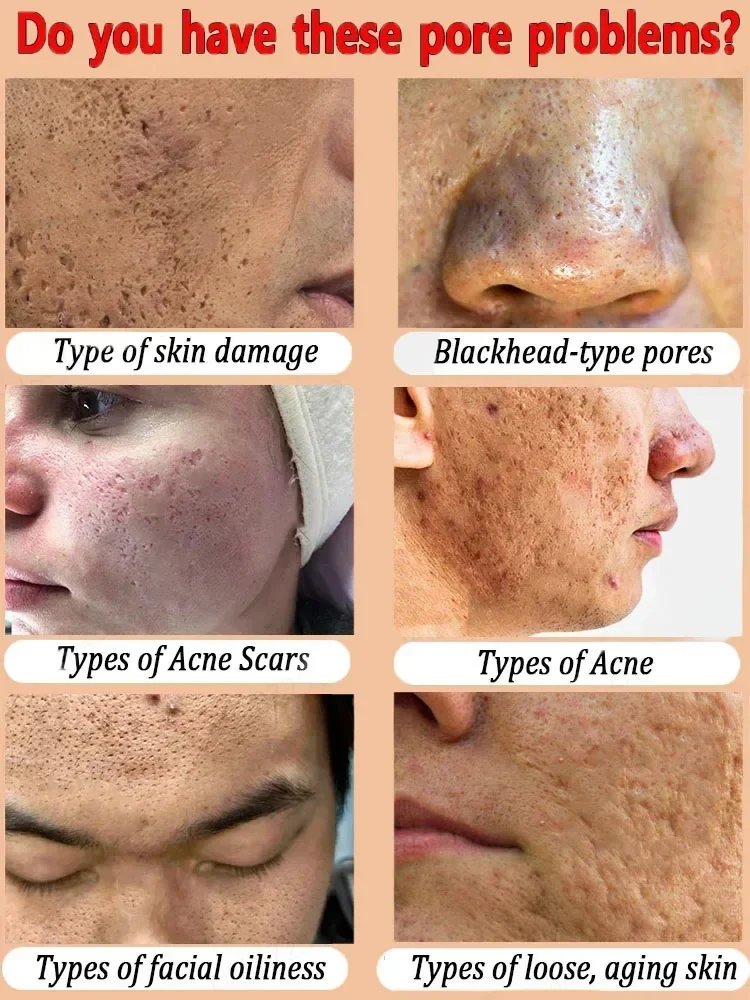 Textura de la piel refinamiento de los poros y regeneraci&oacute;n esencia facial sin acn&eacute;
