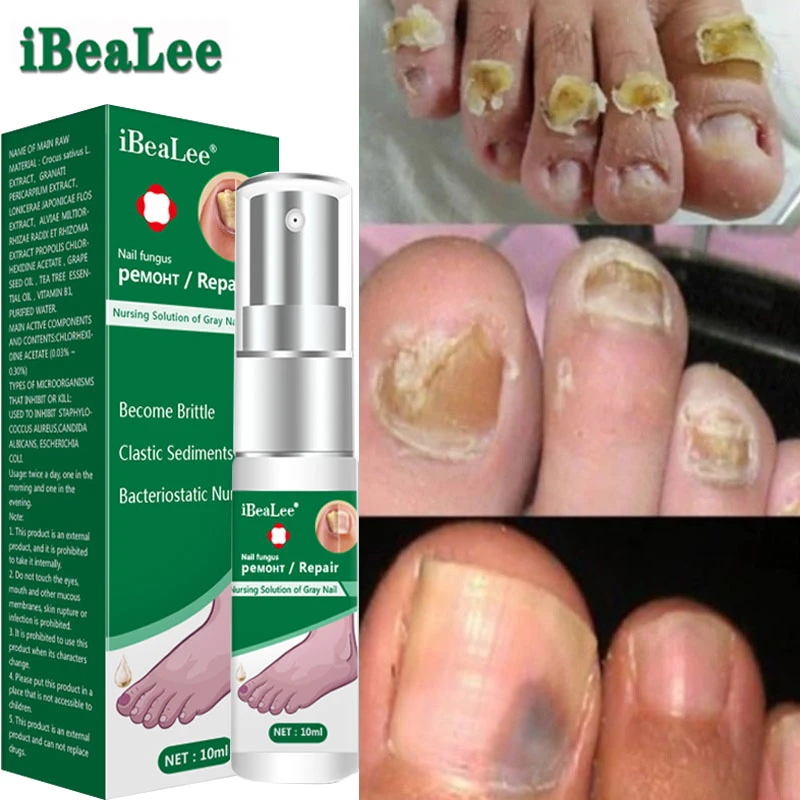 Nail Fungus Treatment Essence Foot Care Anti Infection Paronychia