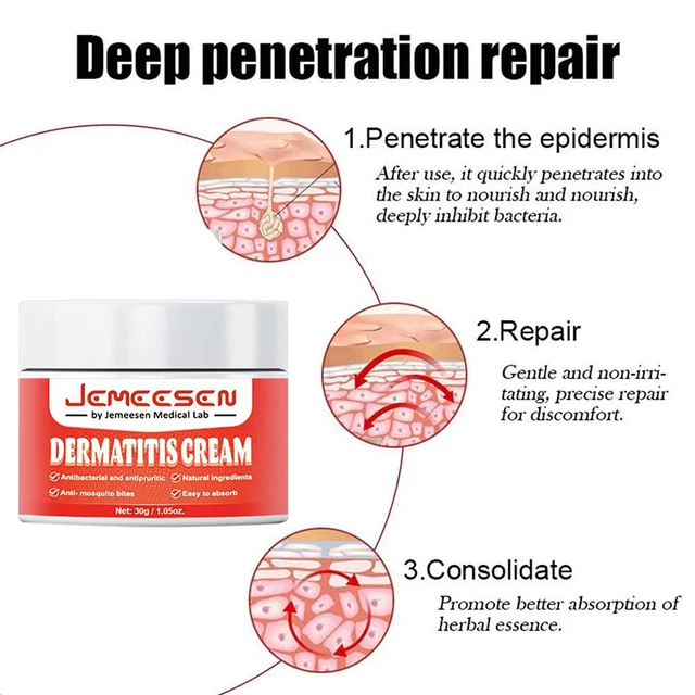 Psoriasis Antibakteriális Krém Dermatitis Ekzematoid Hatékony - Image 3