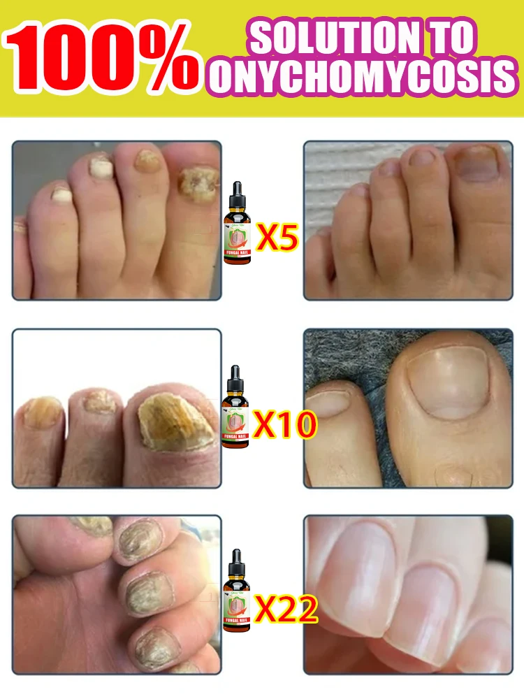 Fungus Solution Organic Essential Oil Toenail Nail Fungus Treatment Repair Fingerail Device Toenail Treatment for Foot Nail Fungus Essential Oil Onychomycosis Care
