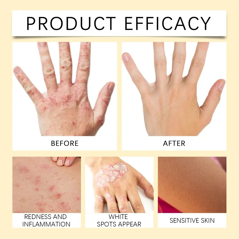Bee Venom Vitiligo Treatment Cream Natural Relief Skin Treatment Soothing White Spot Removal Vitiligo Ointment Eliminate Pigment pain ointment gel