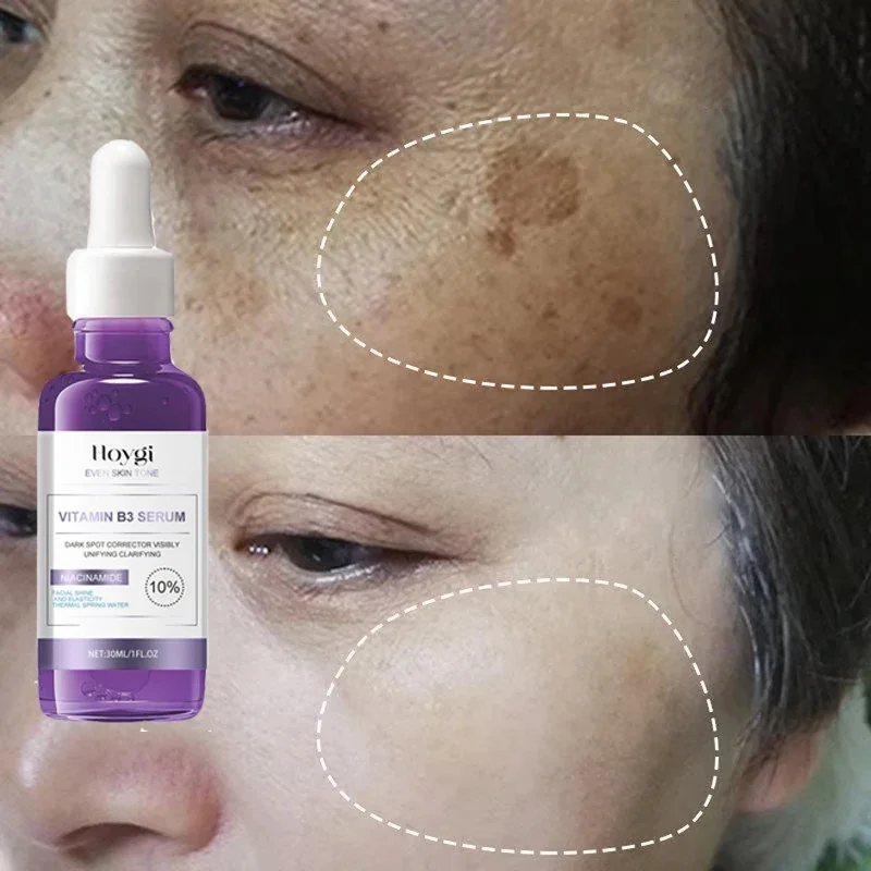 Powerful Dark Spots Remover Whitening Serum Face Freckle Melanin Correcting Anti Pigmentation Brighten Skin Beauty Care Essence 3