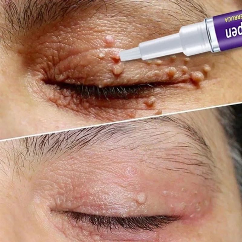 Warts Remover Liquid Antibacterial Ointment Wart Treatment Cream Skin Tag Remover Herbal Extract Corn Plaster Warts Ointment 3 Warts Remover Liquid Antibacterial Ointment Wart Treatment Cream Skin Tag Remover Herbal Extract Corn Plaster Warts Ointment