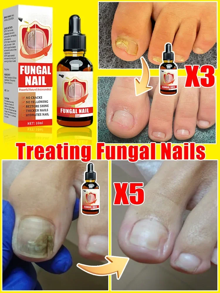 The most powerful black technology in 2024! Completely solve the problem of fungus fungus solution