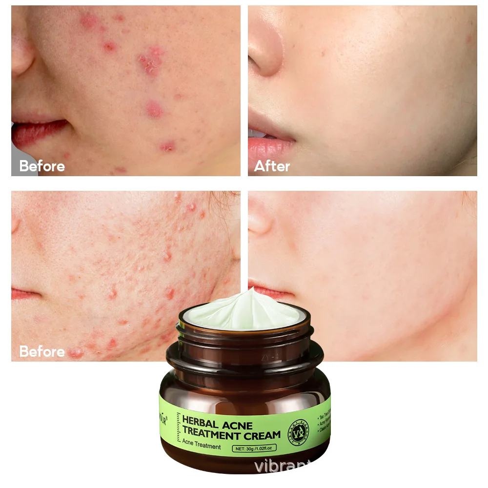 

Herbal Acne Treatment Cream Fade Acne Marks Shrinks Pores Soothing Repair Facial Essence Moisturizing Brighten Smooth Skin Care