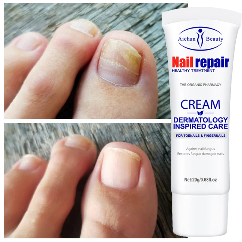 

1pcs Foot Nail Fungus Feet Treatment Products Cuticle Nails Polish Regrowth Cream Remedy Toenail Finger Fungal Care 20g