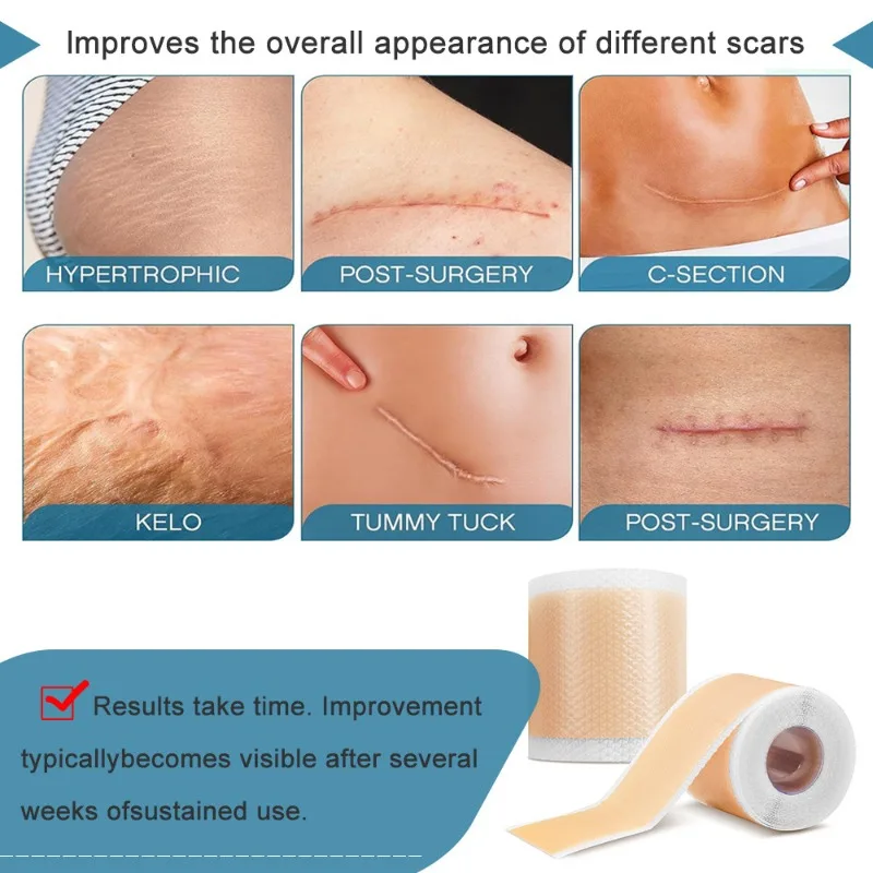 Silicone Scars Sheets Keloid Bump Removal Strips Scars Reducing Treatments Surgical Scars Burn Tummy Tucks Acne C-Section 1 Roll
