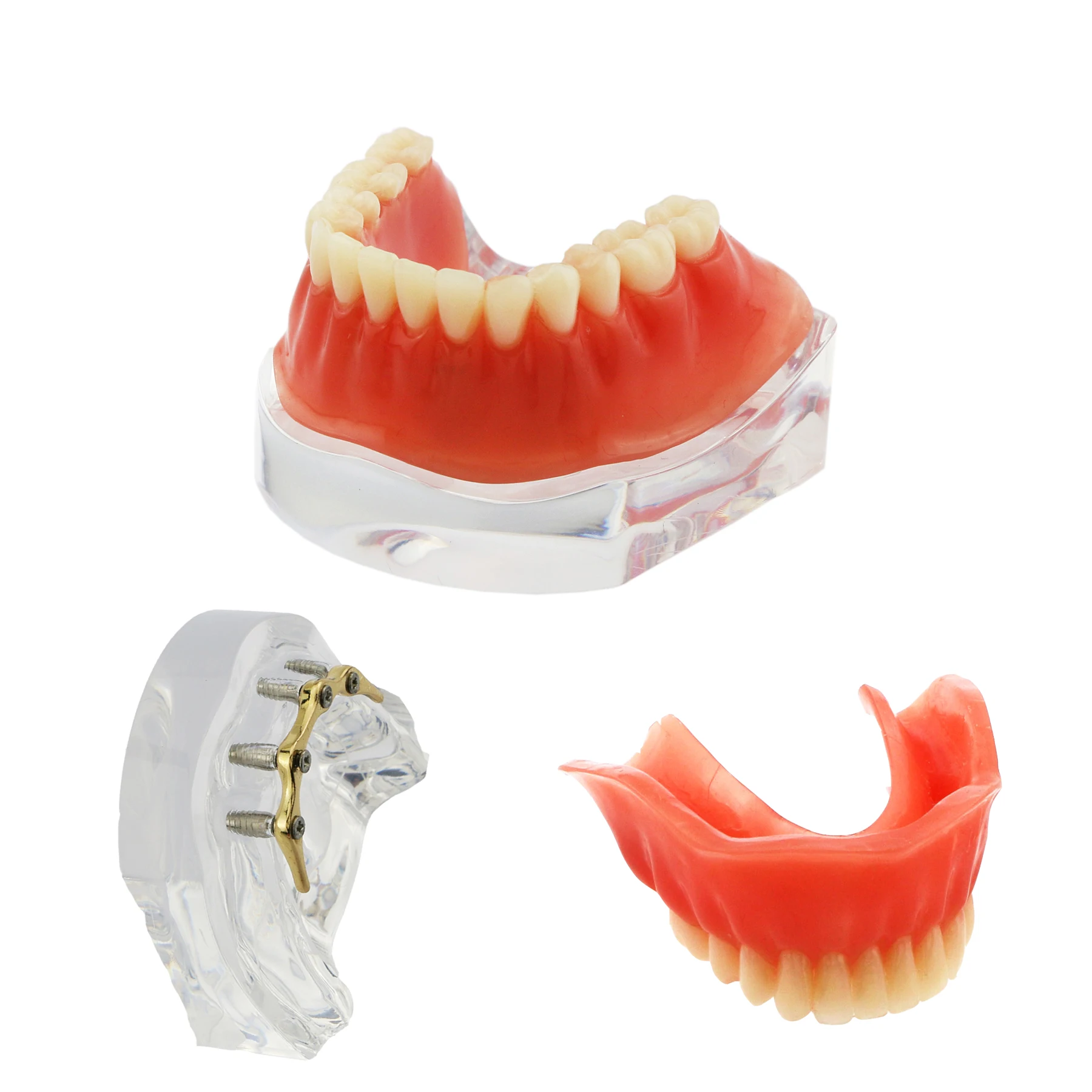 

Dental Implant Teeth Model With Golden Bar Removable Overdenture 4 Implants Inferior Lower Restoration Treatment Demo Study