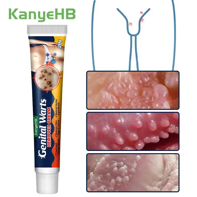 

1Pcs Wart Treatment Cream Skin Tag Genitals Warts Papilloma Flat Warts Remove Antibacterial Herb Medical Cream Health Care G046