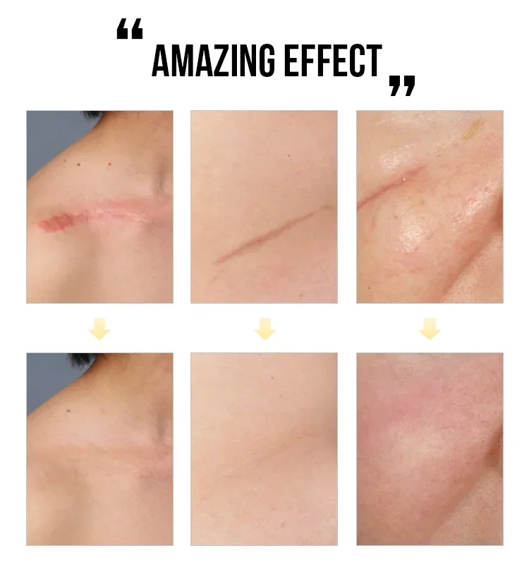 Scar Removal Cream Gel Remove Acne Spots Treatment Stretch Marks Burn Surgical Scar Repair ointment for Whitening Skin Beauty