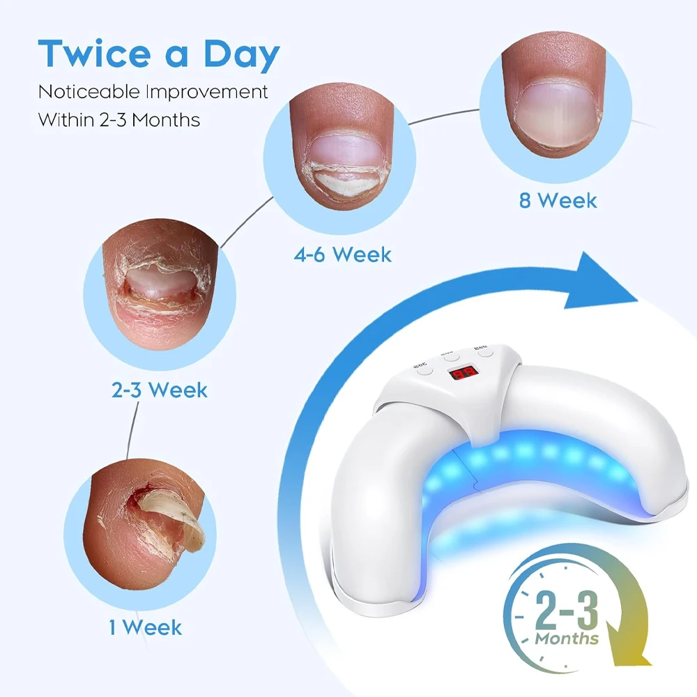 Nail fungus remover Nail Fungus Laser Treatment Device Fingernail Fungus Treat Onychomycosis Therapy Effectively Remove Onychomycosis Grow Toe Nail