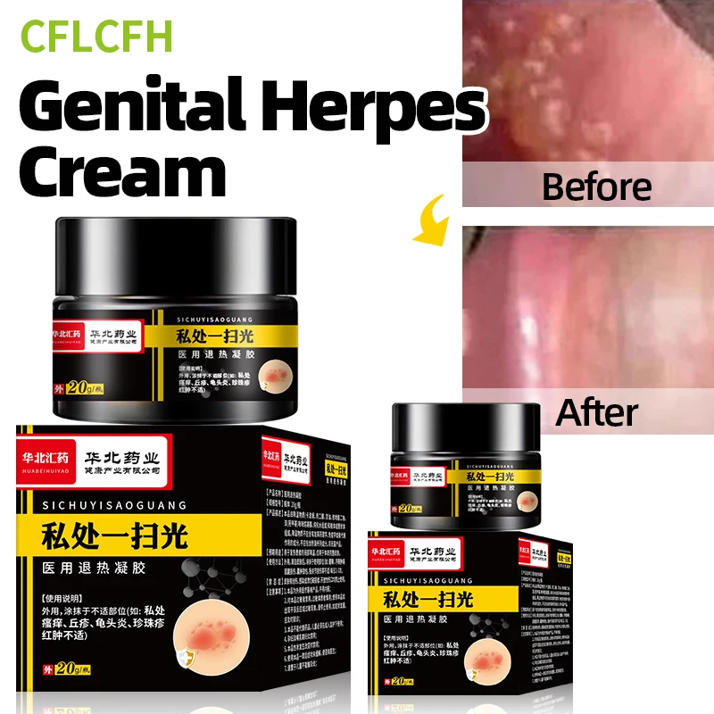 Genital Herpes Removal Mens Balanitis Candida Treatment Cream Ointment Medicine Cure Pearly Papules Remover 20g 2Boxes