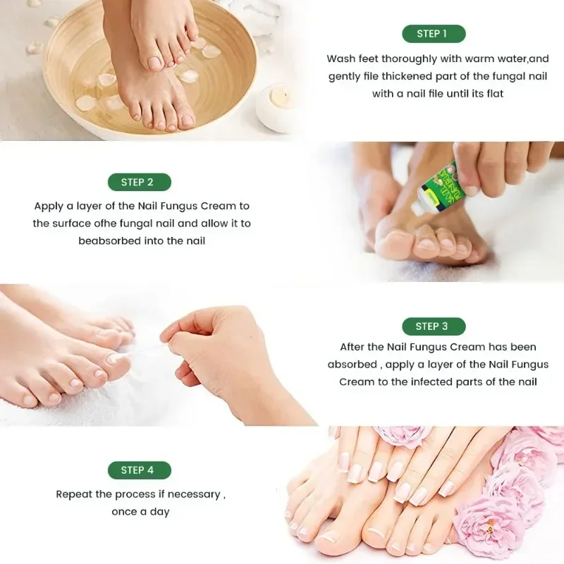 Nail Fungus Treatment Cream Onychomycosis Paronychia Anti Fungal Nail Infection Fights Bacteria and Fungus Naturally Oint U&ntilde;as nail fungus remover