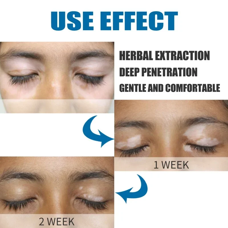 20g Vitiligo Removal Cream Fast Acting Leukoplakia Vitiligo Repair Cream Natural White Spot Soothing Ointment Health Care