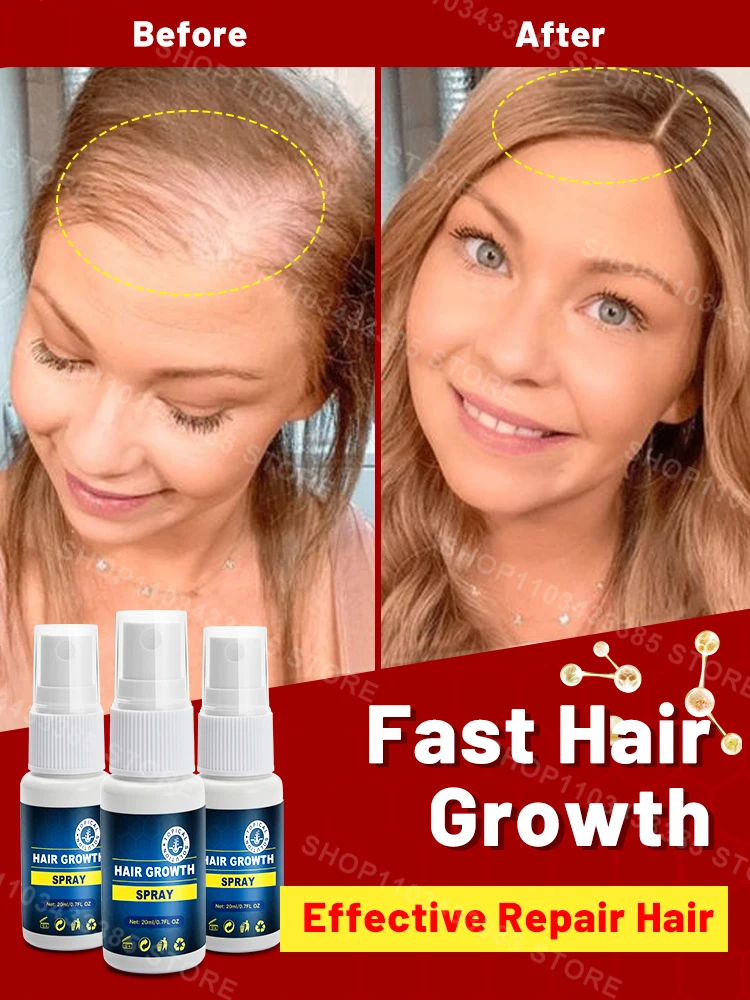 FastHairGrowthSprayHairRegrowthHairThinningTreatmentHair