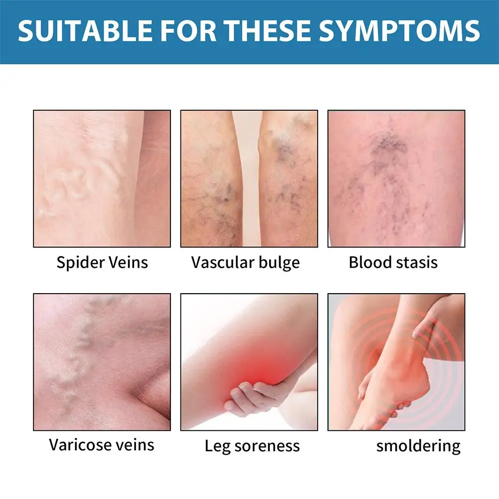 Varicose Vein Ointment 20g Varicose Vein Repair Cream Phlebitis Worm Spider Legs Vessel Pain Treatment Soothing Reduce Swelling Cream