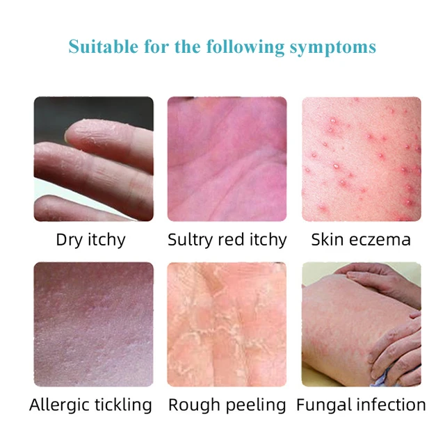 Psoriasis Krém Ekcéma Kenőcs Kezelés Kéz Tinea Pedis Gátolja A Dermatitis Gombaellenes Krémet - Image 5