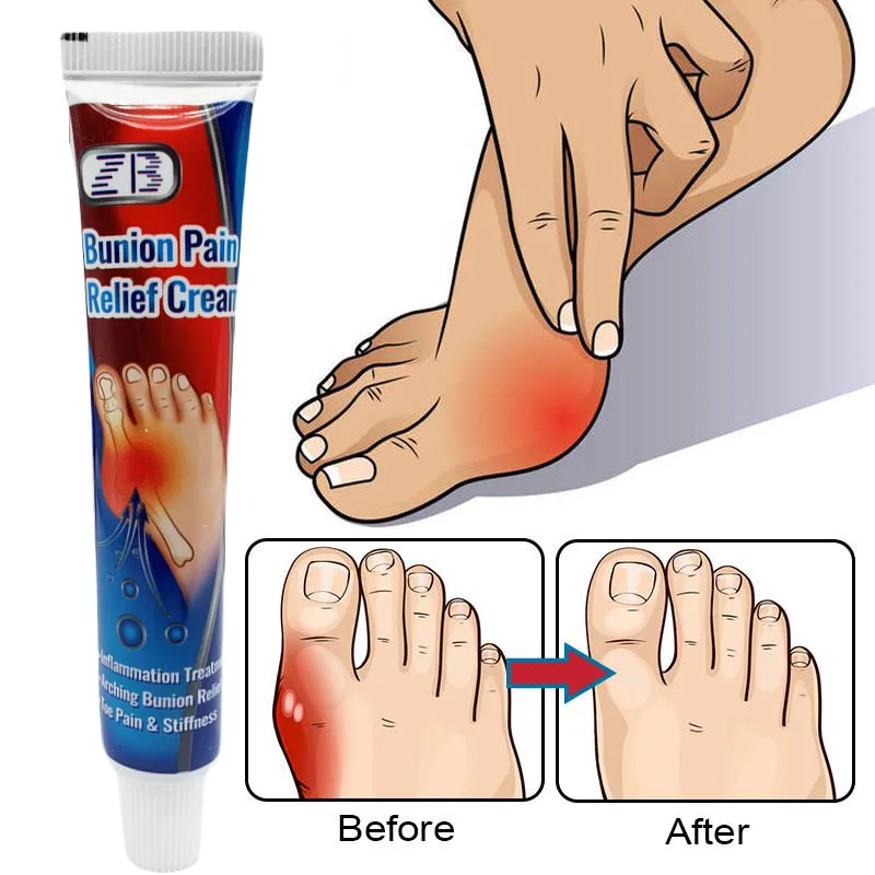 

20g Bunion Gout Pain Relief Ointment Toe Joint Valgus Corrector Cream Hallux Knee Lumbar Arthritis Treatment Medical Plaster