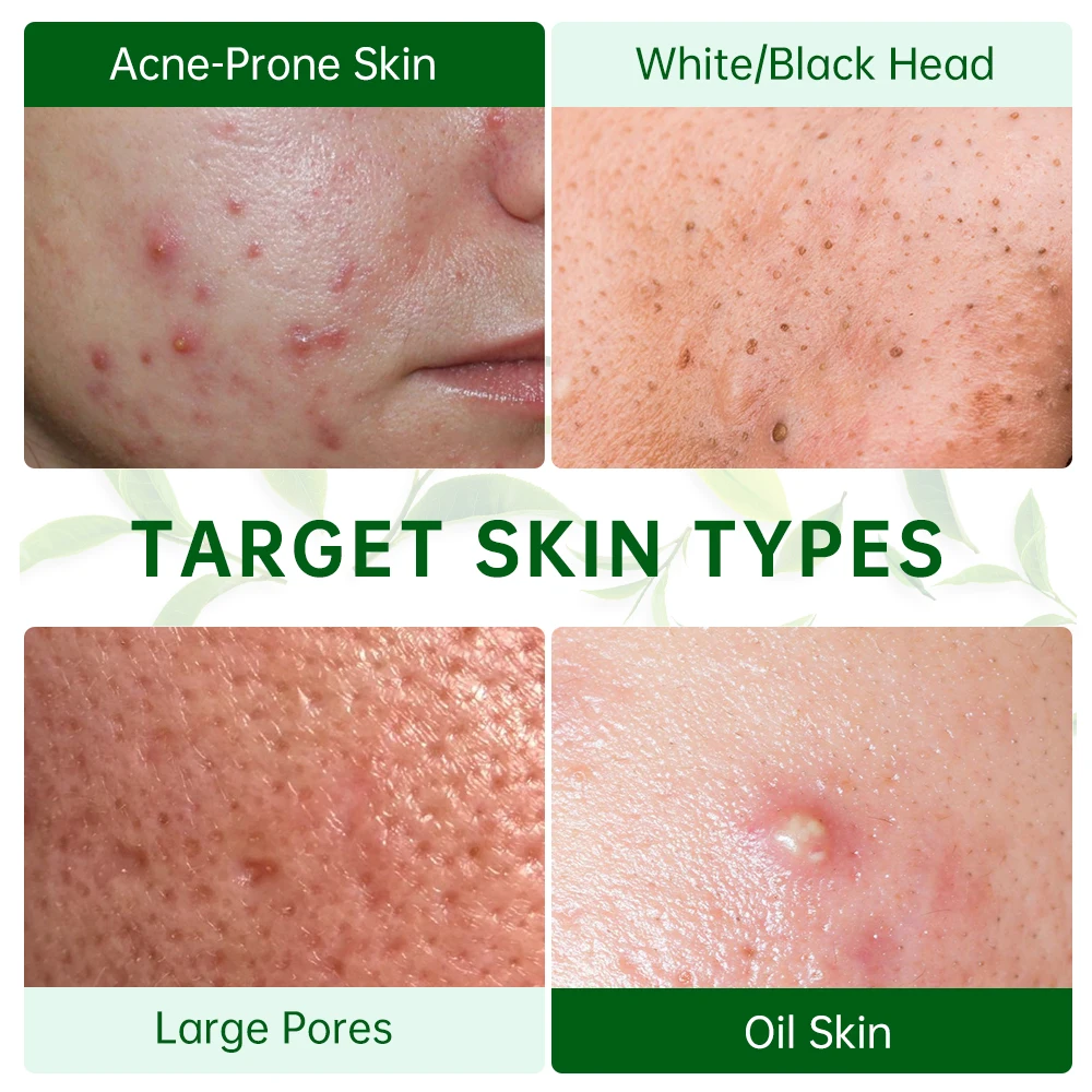 Acne Treatment Facial Mask 2