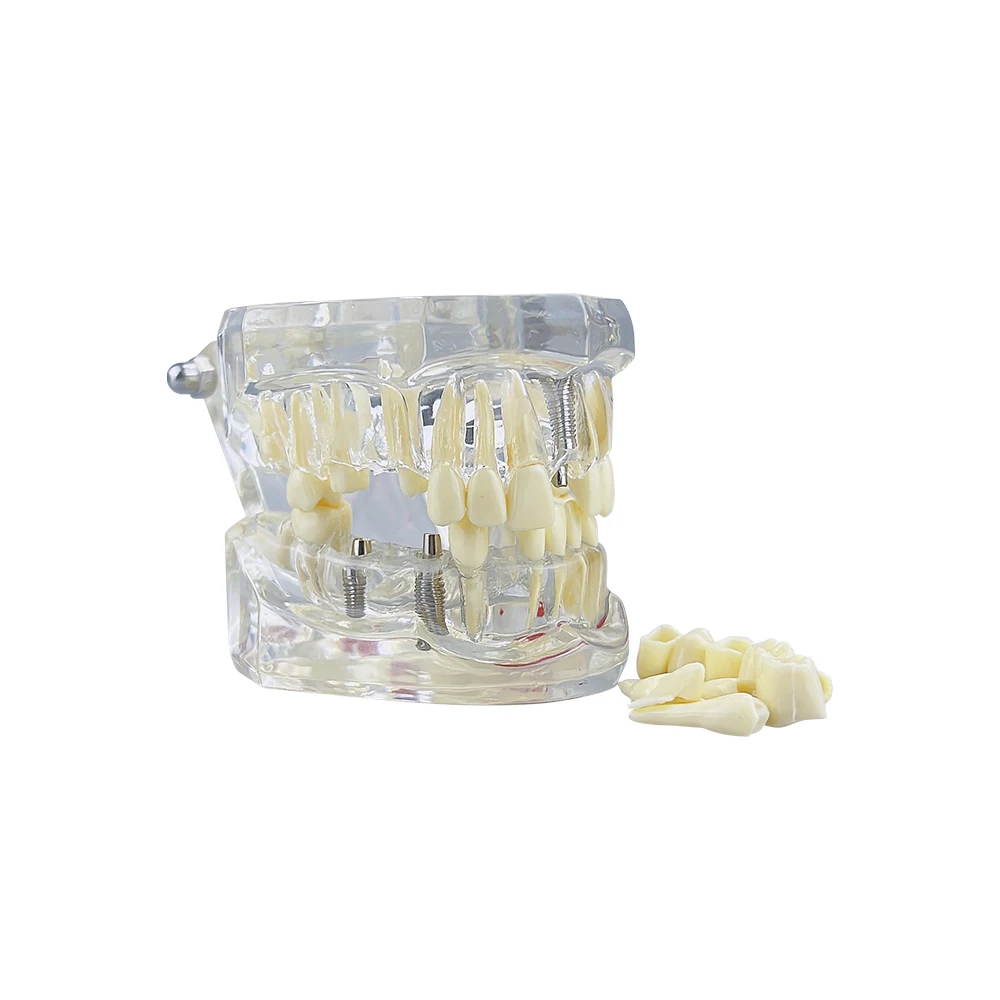 Teeth Repair Model Disease Teeth Model for Dentist Student Practice Training Studying Oral Medical Dentistry Tools