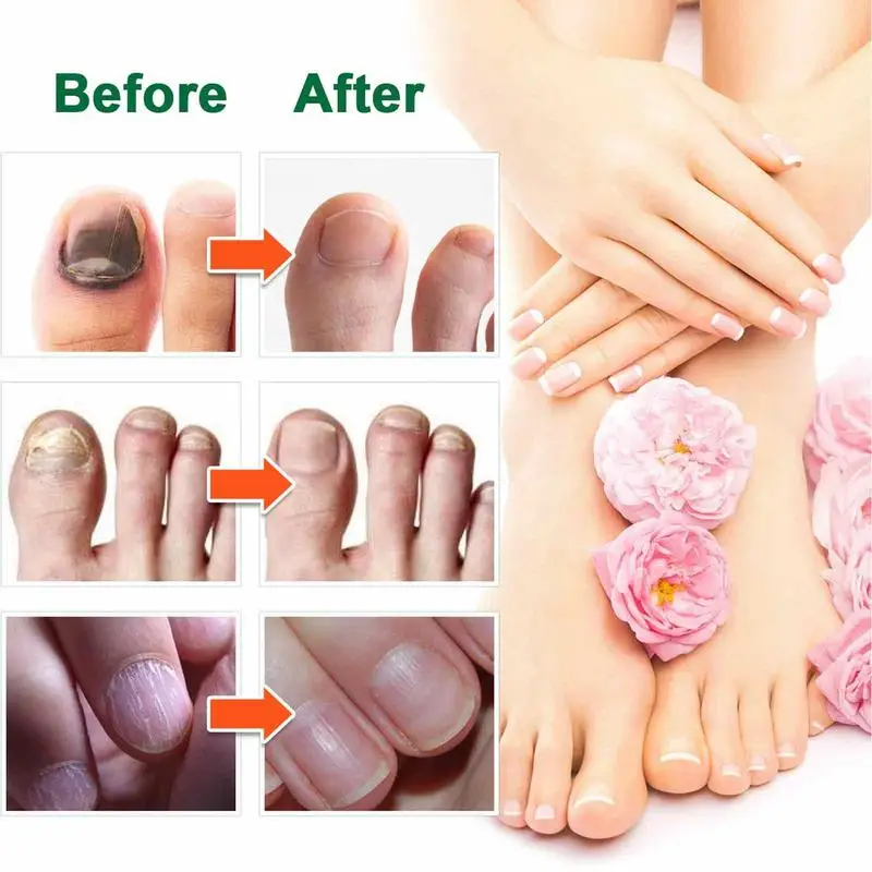 Mineral Mud Supports Healthy Toenails Product Features Healthy Toenails