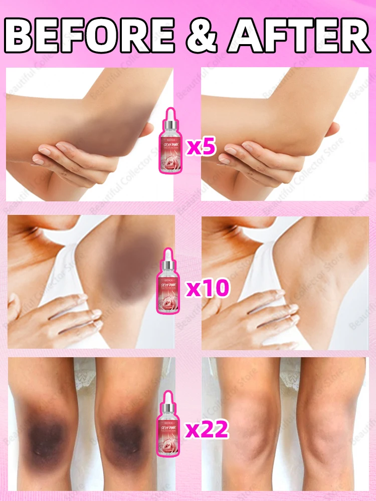 Whitening Cream Private Parts Underarm Bleaching Serum Whiten Butt Knee Brighten Inner Thigh Intimate Parts Dark Remove Melanin