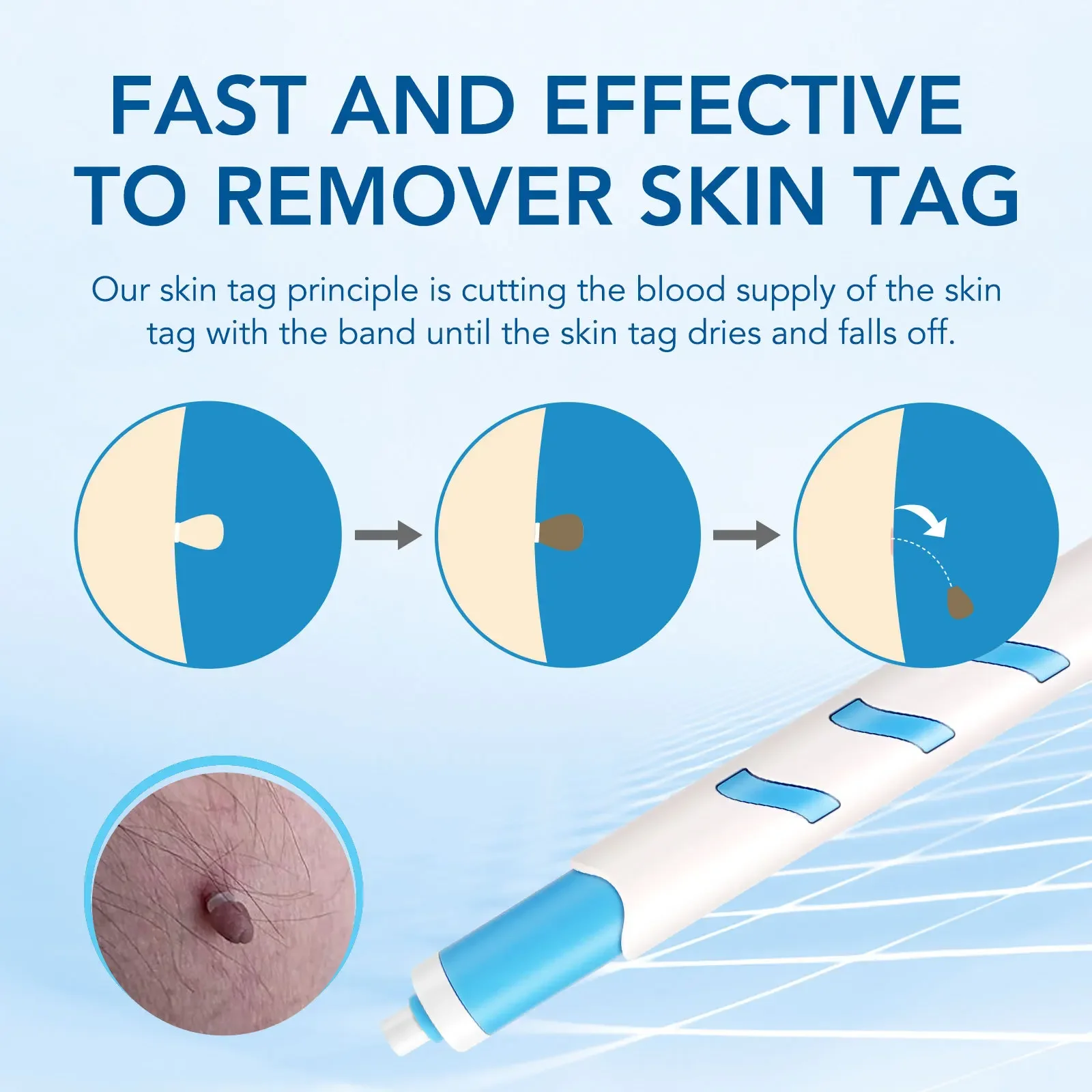 Skin Tag Removal Pen Home Use Painless Safe Skin Tag Mole Wart Spot Removal Equipment for Smooth Skin