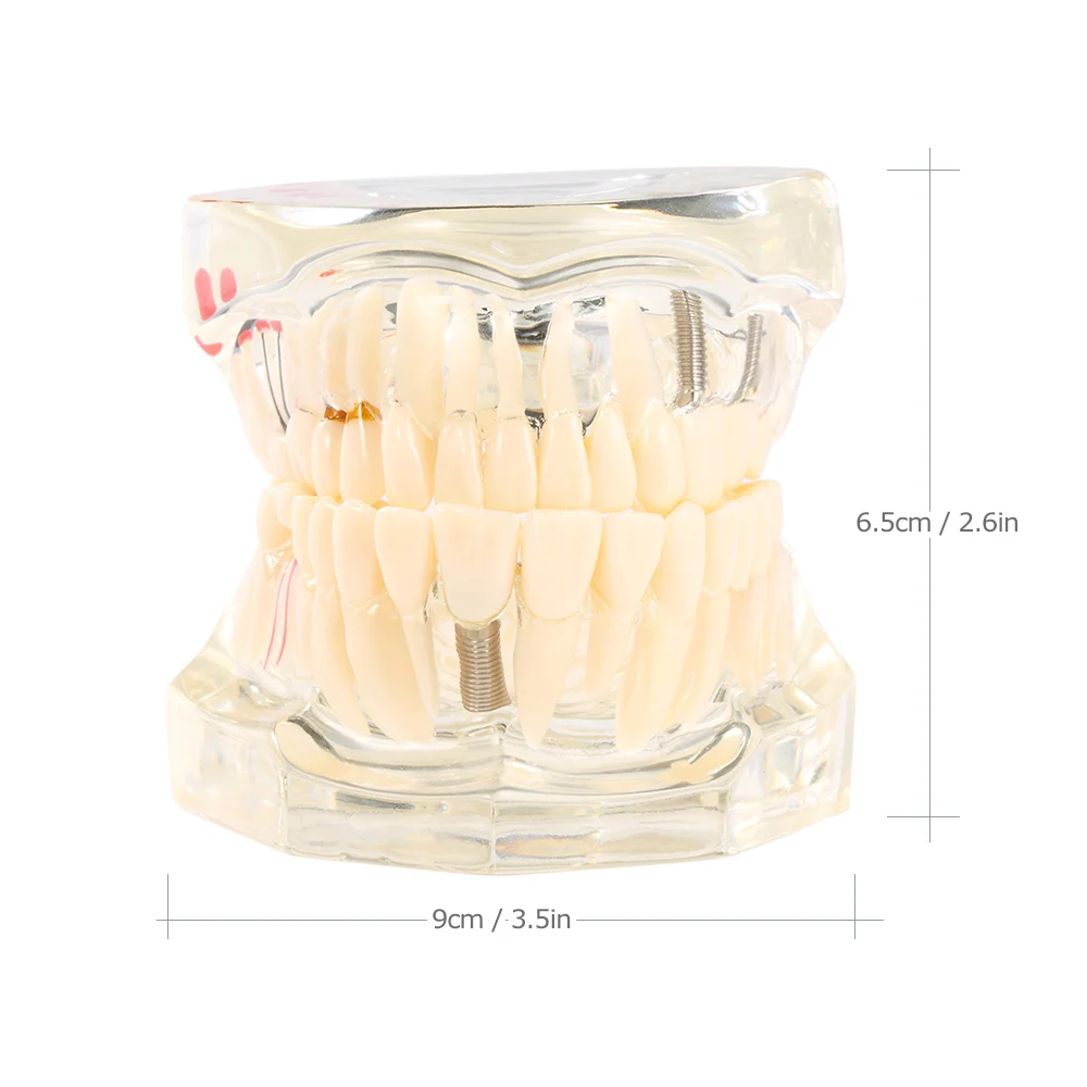 Dental Implant Resin Model for Dental Disease Education and Research