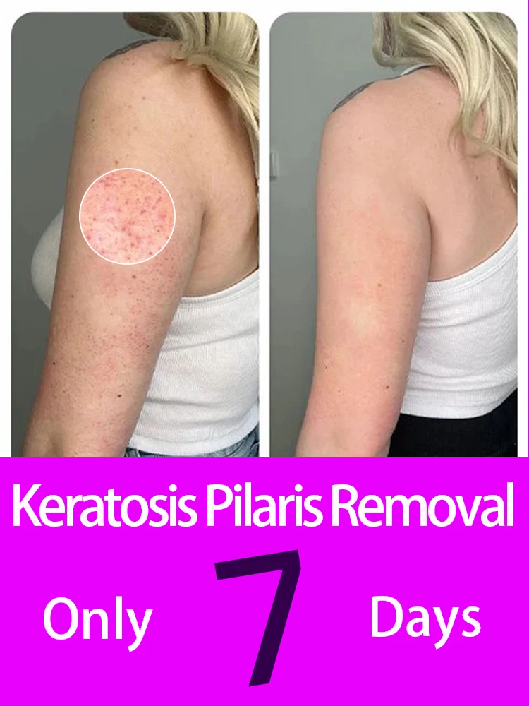 KP Body Scrub Treatment Remover kp Body Scrub Chicken Skin Removal