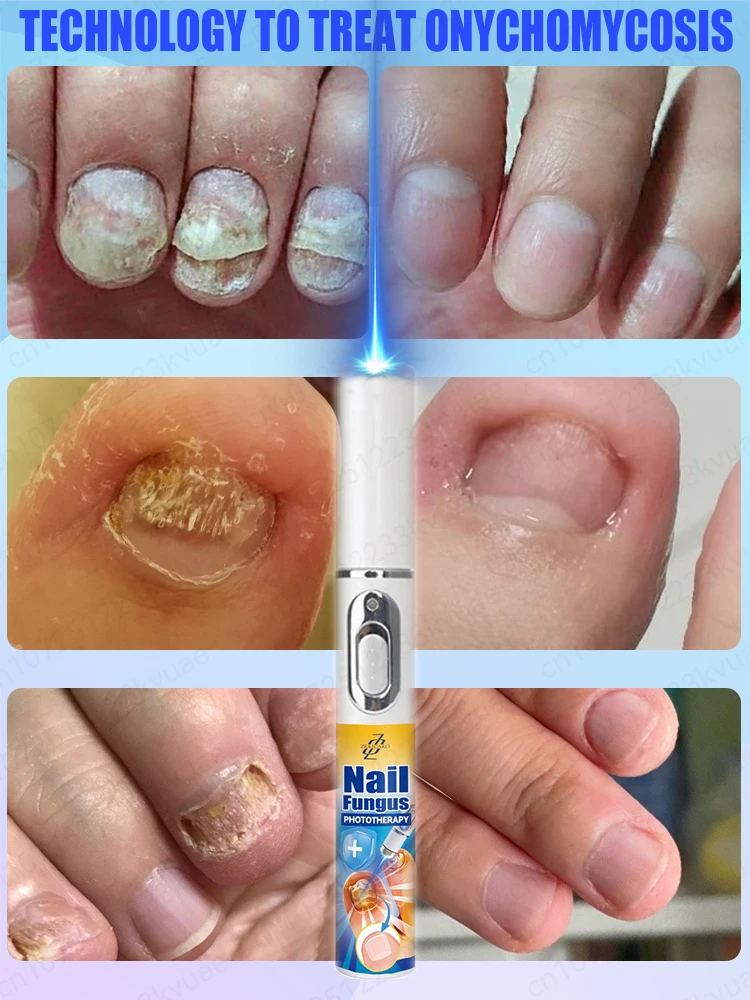 Technology changes pain effectively treats onychomycosis and nail fungus refuses drug treatment