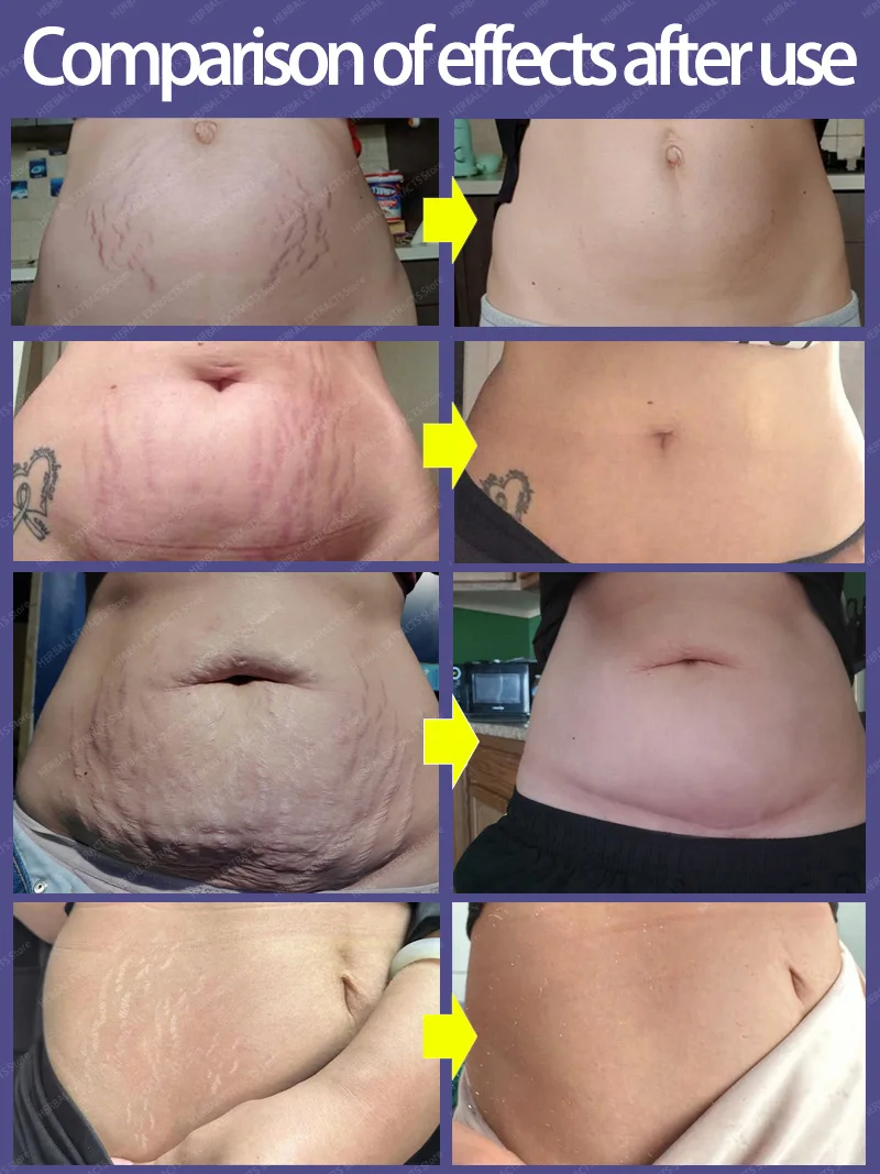 Рисунок 5 - Крем для перманентного Удаления растяжек