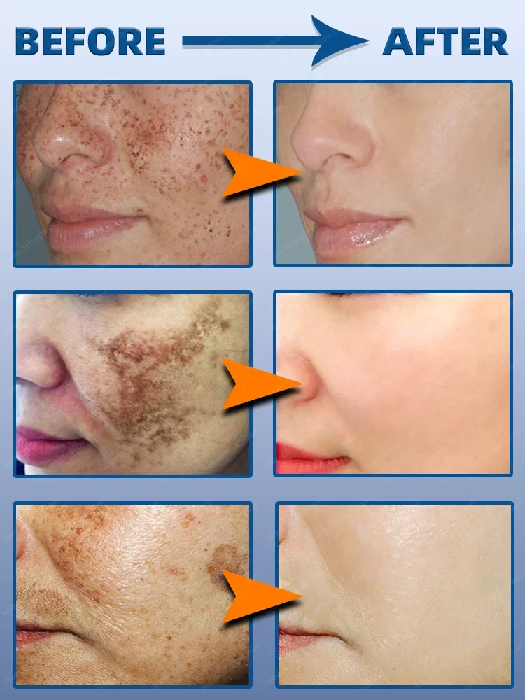 Dark Spot Remover For Face Cream Black Age 4